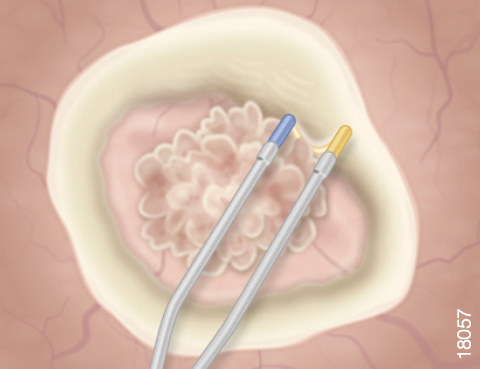 Transurethral PLASMA En Bloc Resection of NMIBC Bladder Endo Dissection ...